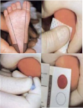 新生儿采血卡.jpg 新生儿采血卡.jpg